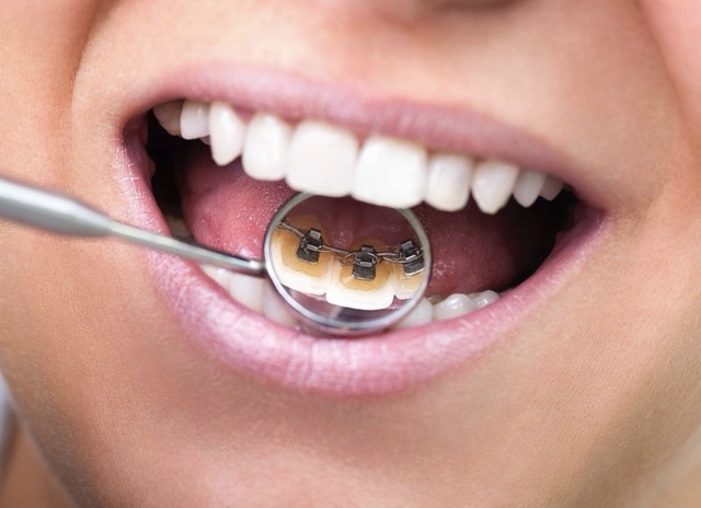 Лингвальные брекеты