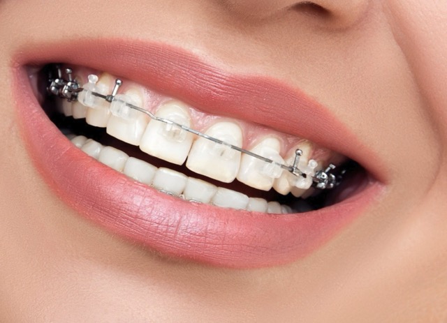 Сапфировые брекеты